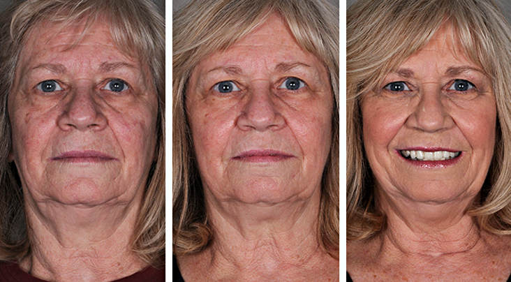 Лазерная дермабразия - фотографии до и после шлифовки