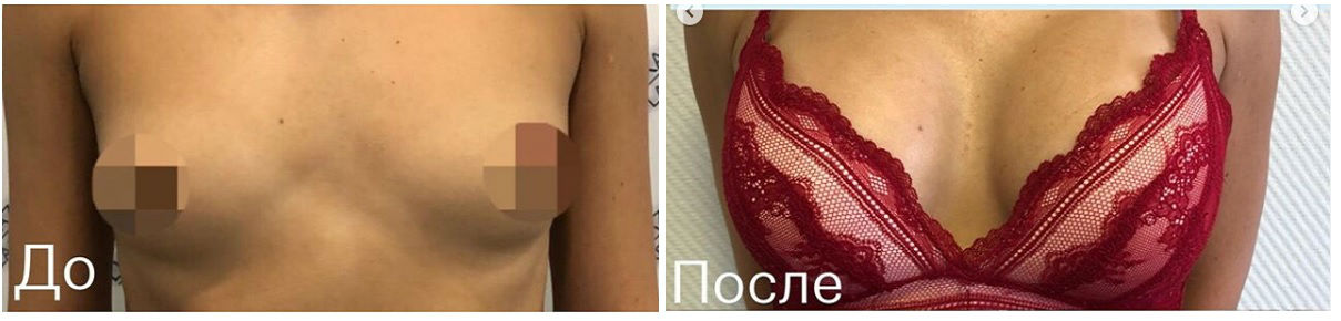 Фото до и после маммопластики у пластического хирурга Казанцева Евгения Владимировича