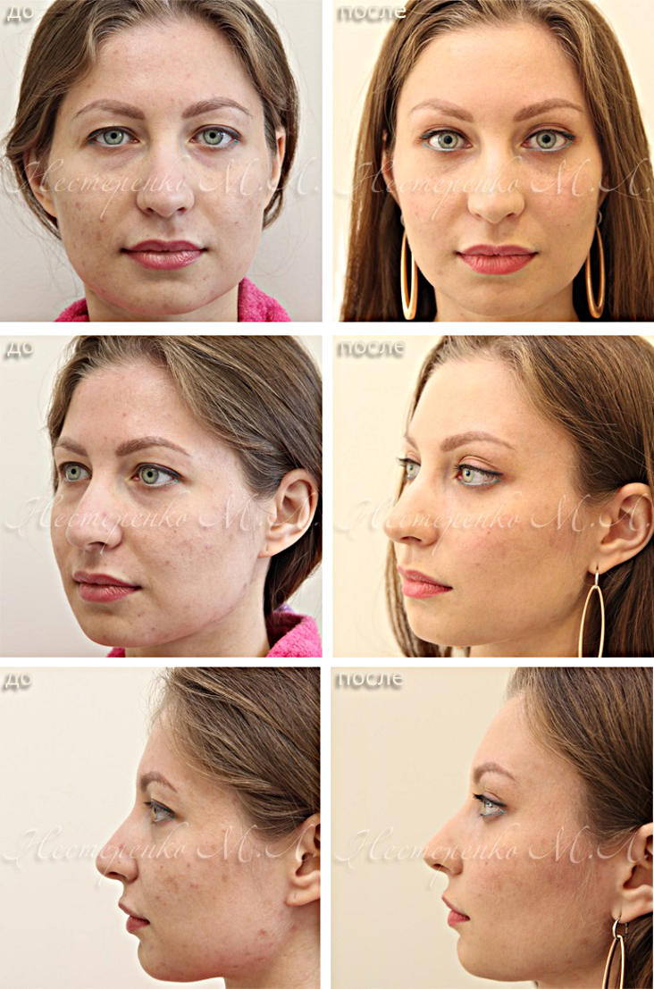Фотография до и после подтяжки лица (фейслифтинга)