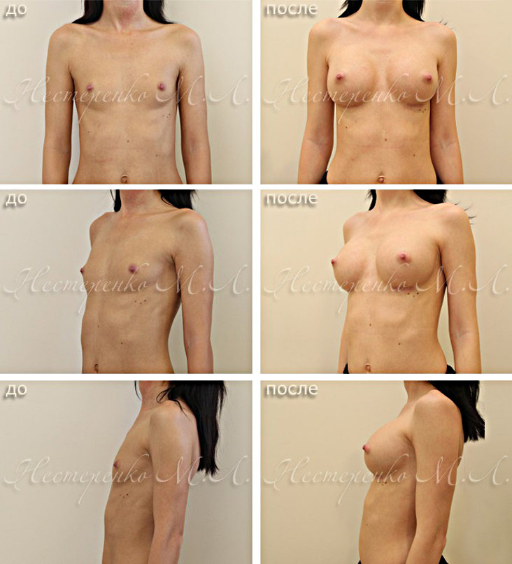 До и после маммопластики - операции по увеличению груди