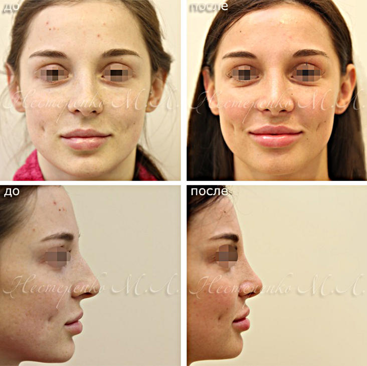 Пластика носа - фотография до и после операции