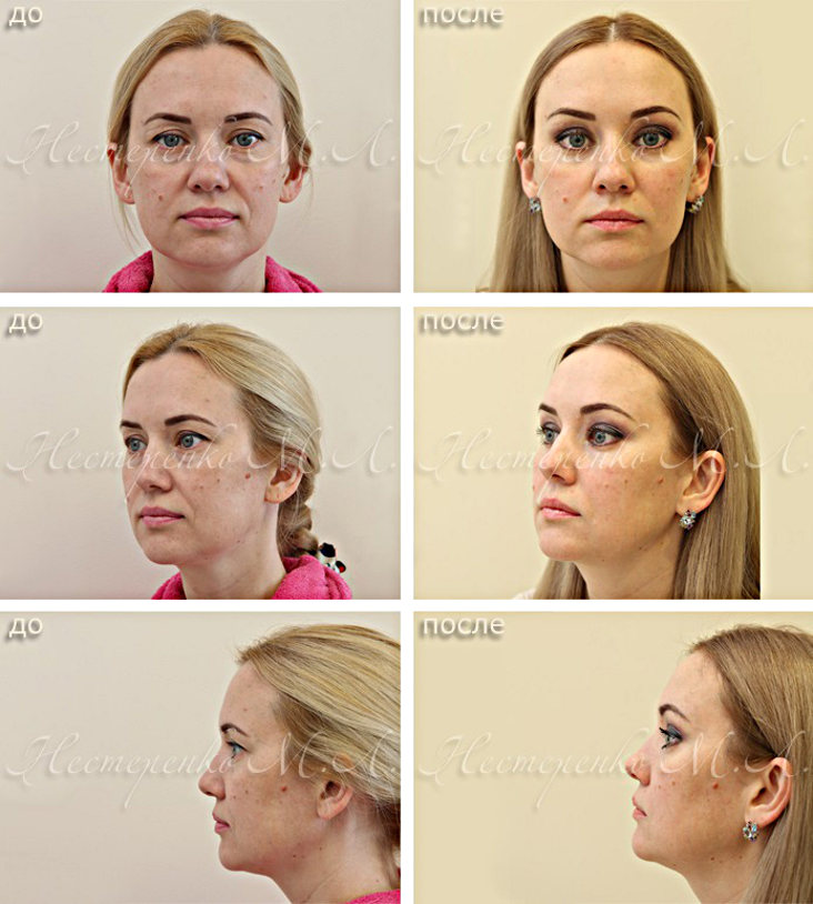Фотографии до и после подтяжки лица (лба и бровей)