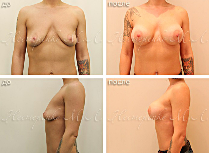 До и после операции по увеличению груди имплантами