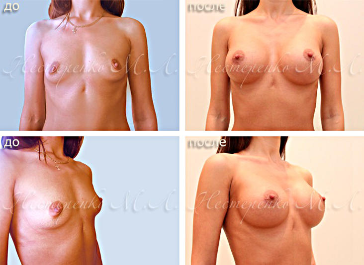 Фотографии до и после увеличения груди