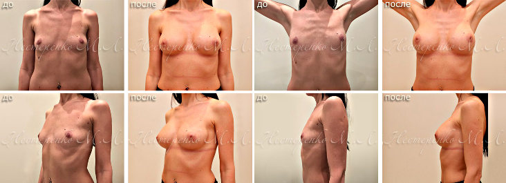 Фотографии до и после увеличения маленькой груди
