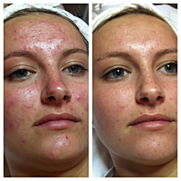 Фото до и после аппаратной чистки лица HydroFacial