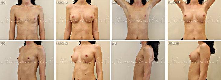 Фотографии до и после маммопластики с установкой имплантов Арион (Arion)