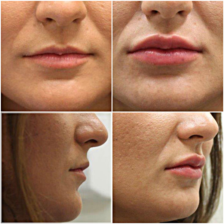 Фотографии до и после увеличения губ (контурной пластики)