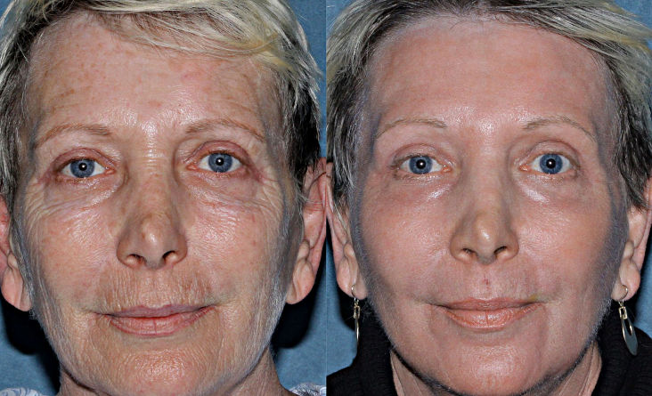 Фото до и после омоложения кожи лица на лазере Фраксель (Fraxel)