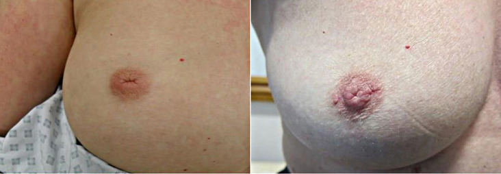 Фотографии до и после операции по коррекции втянутого соска и уменьшения ареолы груди