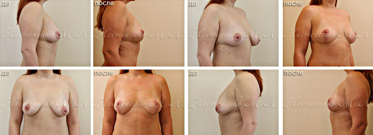 Фотографии до и после коррекции обвисания молочных желез