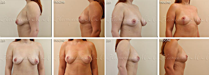 Фотографии до и после хирургического лечения мастоптоза