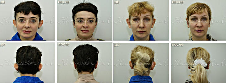 Фотографии до и после операции пластики ушей (отопластики)