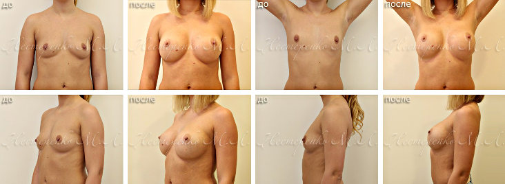 Политех - фотографии до и после установки имплантов груди