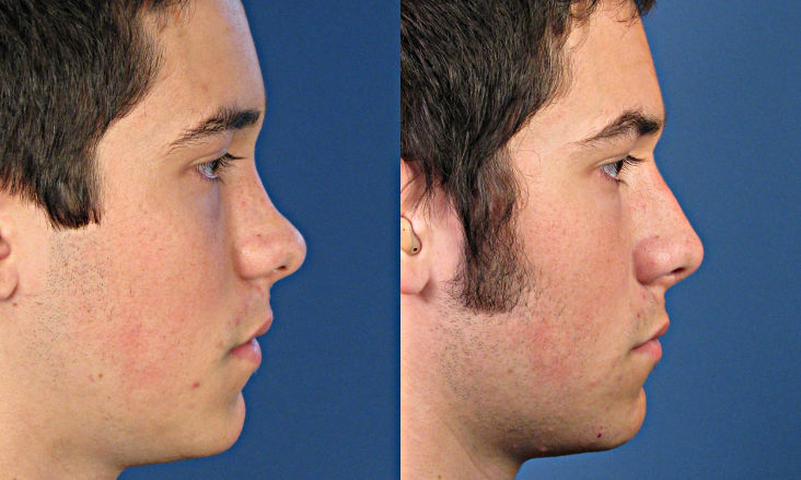 Фотографии до и после ринопластики седловидного носа