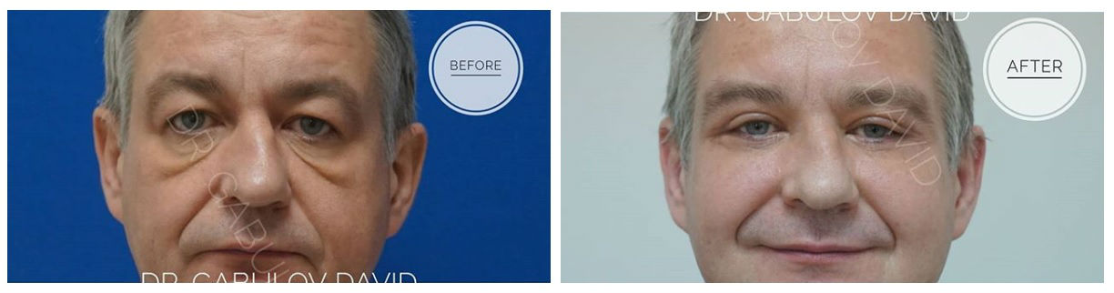 Фото до и после операции пластики век у пластического хирурга Габулова Давида Албеговича