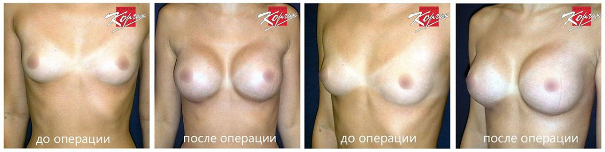 Фото до и после операции на груди у пластического хирурга Корчака Владимира Васильевича