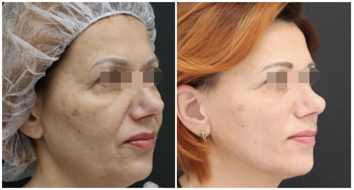 Фото до и после операции на лице у пластического хирурга Круглика Сергея Викторовича