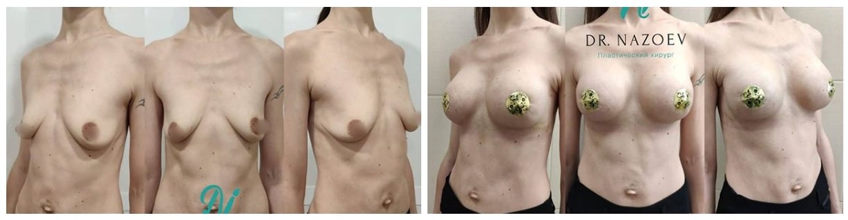 Фото до и после маммопластики у пластического хирурга Назоева Кирилла Владимировича