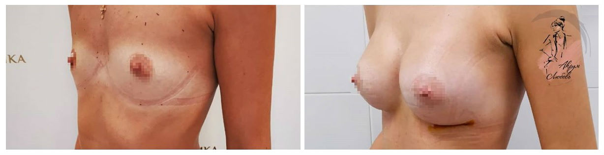 Фото до и после пластики груди у пластического хирурга Акрум Любовь Николаевны