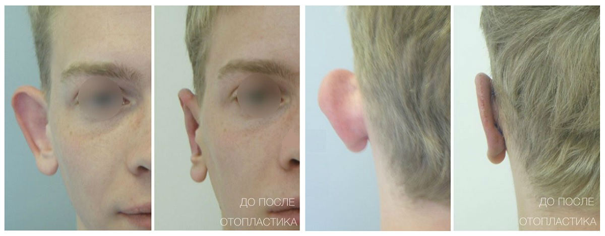 Фото до и после пластики ушной раковины у пластического хирурга Эфендиева Магомеда Магомедовича