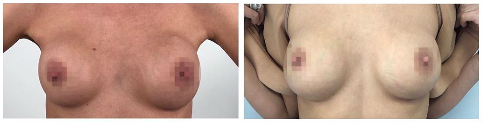 Фото до и после пластики груди у пластического хирурга Гладышевой Владиславы Владиславовны