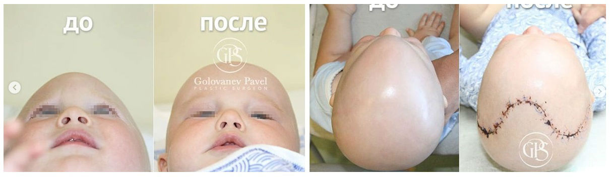 Фото до и после пластики черепа у пластического хирурга Голованева Павла Сергеевича