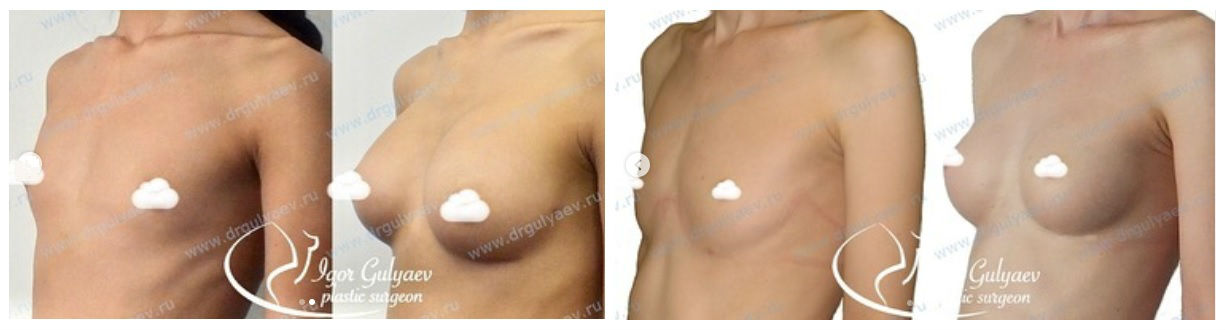 Фото до и после пластики груди у пластического хирурга Гуляева Игоря Валерьевича