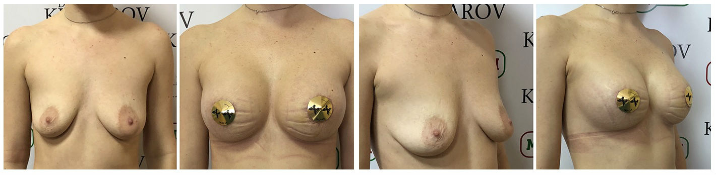 Фото до и после маммопластики у пластического хирурга Хайдарова Тимура Тошниёзовича