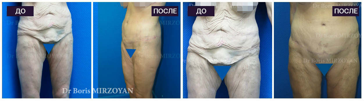Фото до и после пластики тела у пластического хирурга Азизяна Ваагна Самвеловича