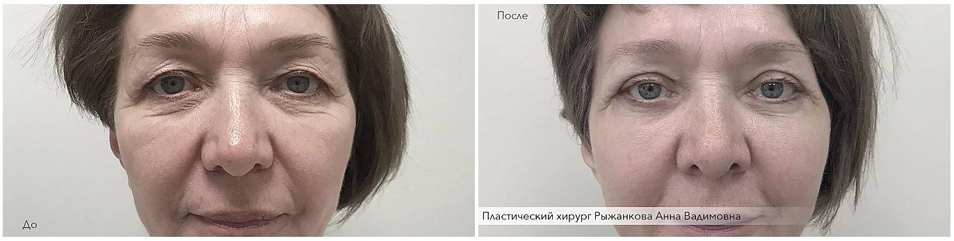 Фото до и после операции блефаропластики у пластического хирурга Рыжанковой Анны Вадимовны
