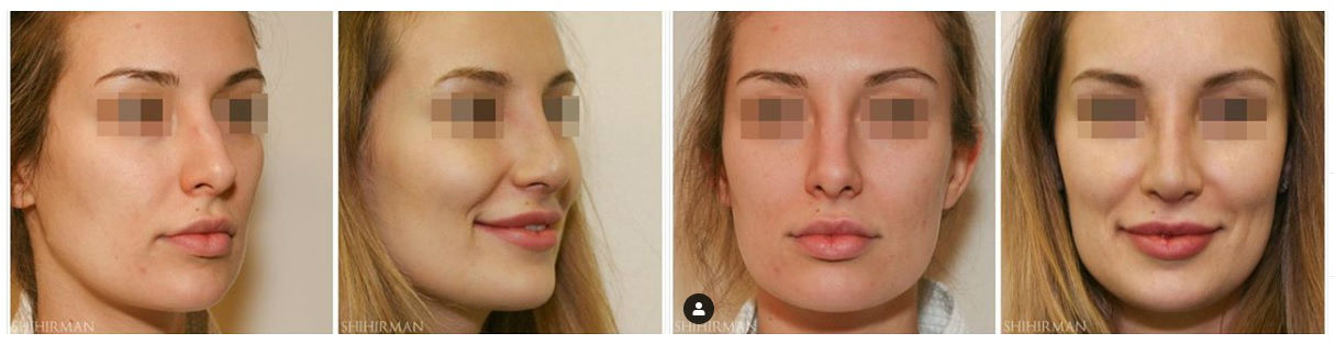 Фото до и после пластики носа у пластического хирурга Шихирмана Эдуарда Вадимовича
