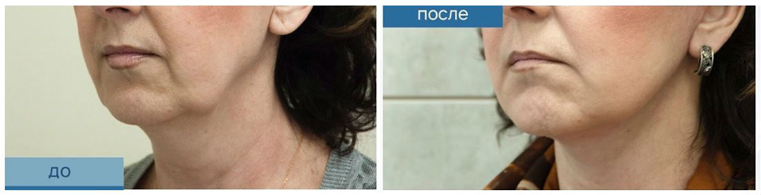 Фото до и после подтяжки лица у пластического хирурга Сизова Сергея Владимировича