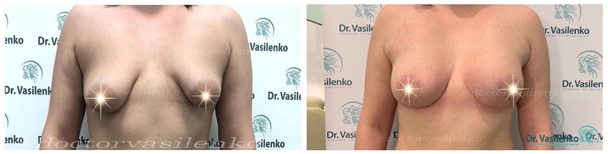Фото до и после маммопластики у пластического хирурга Василенко Ирины Николаевны