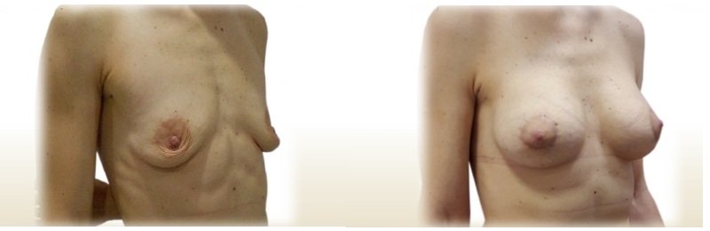Фото до и после пластики груди у пластического хирурга Золотых Валерия Геннадьевича