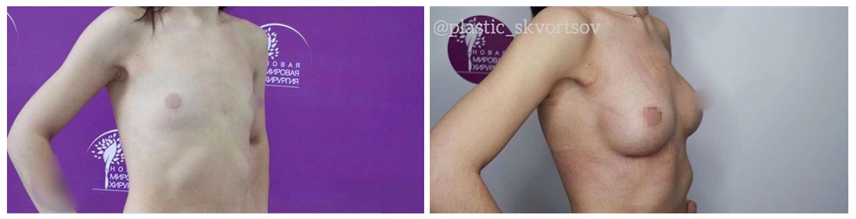 Фото до и после операции по увеличению груди у пластического хирурга Скворцова Дмитрия Сергеевича