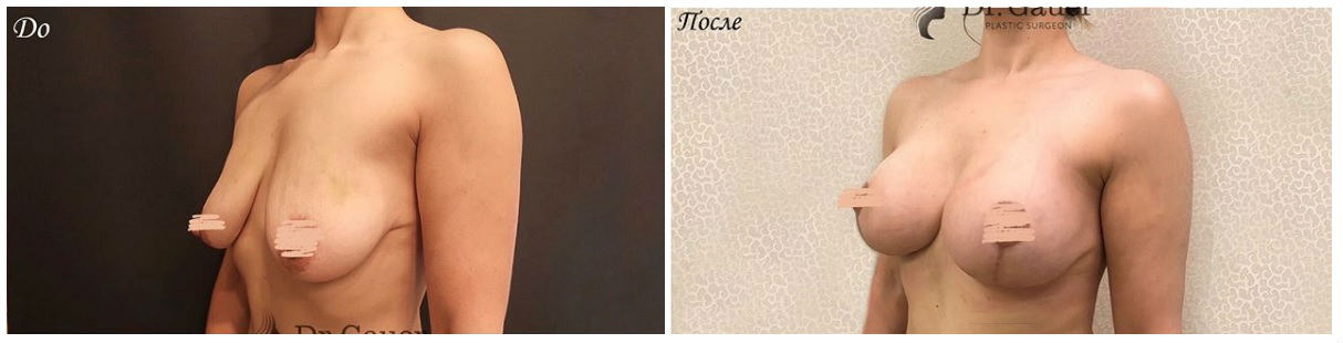 Фото до и после маммопластики у пластического хирурга Гауэр Любовь Николаевны