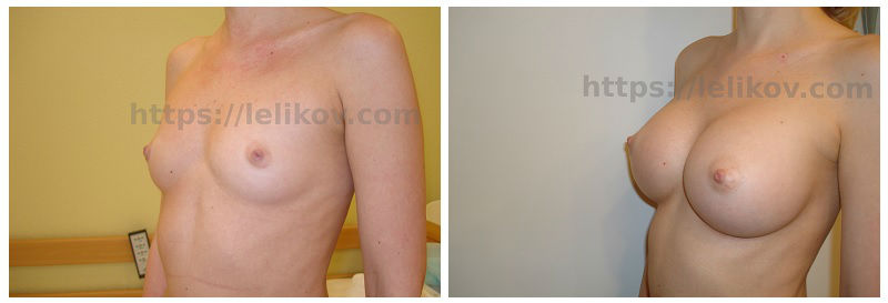 Фото до и после маммопластики у пластического хирурга Леликова Андрея Славовича