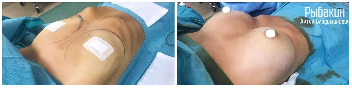 Фото до и после маммопластики у пластического хирурга Рыбакина Артура Владимировича