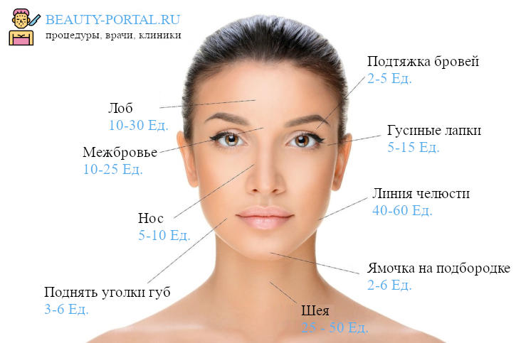 Инъекции ботокса - зоны на лице и дозировка