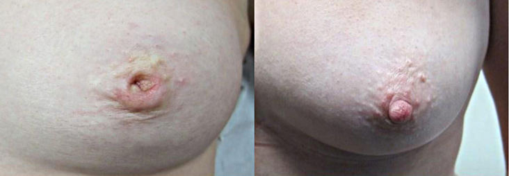 Фотографии до и после операции коррекции втянутого соска