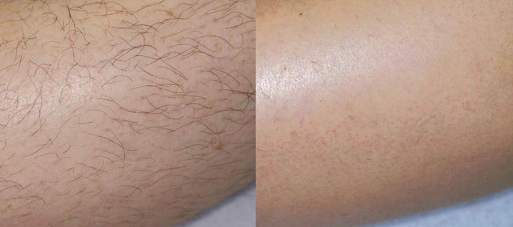 Фотография до и после лазерной эпиляции волос Лайт Шир Дуэт