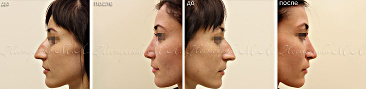 Фотографии до и после удаления горбинки на носу