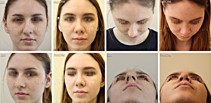 Фотографии до и после ринопластики носа картошкой