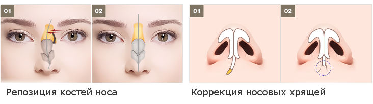 Можно вправить нос. Инструментальная репозиция костей носа. Репозиция костей носа восстановление.