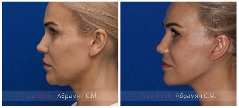 Фото до и после операции у пластического хирурга Абрамяна Соломона Маисовича
