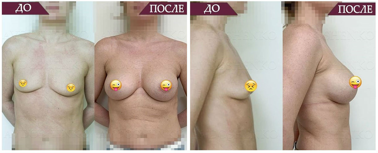 Фото до и после маммопластики у пластического хирурга Авдошенко Ксении Евгеньевны
