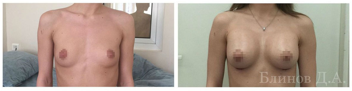 Фото до и после операции у пластического хирурга Блинова Дмитрия Александровича