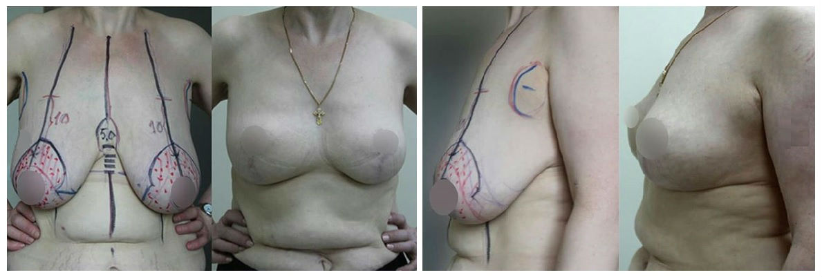 Фото до и после маммопластики у пластического хирурга Боровикова Алексея Михайловича