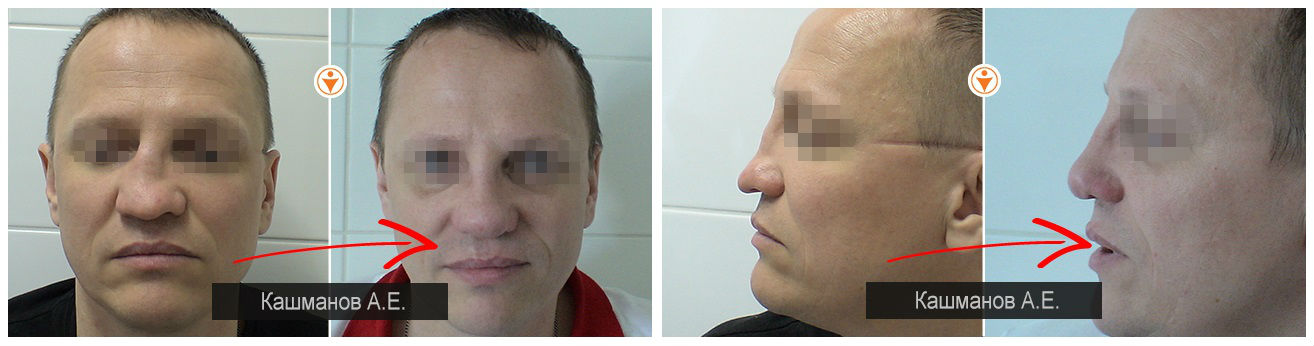 Фото до и после ринопластики у пластического хирурга Кашманова Андрея Евгеньевича